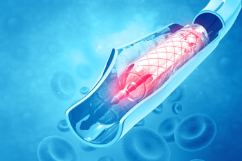 Chemical Characterisation of Medical Devices